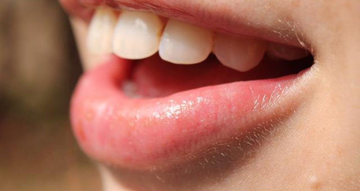 Beberapa Cara Untuk Memutihkan Gigi dengan Bahan Alami