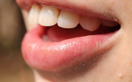 Beberapa Cara Untuk Memutihkan Gigi dengan Bahan Alami